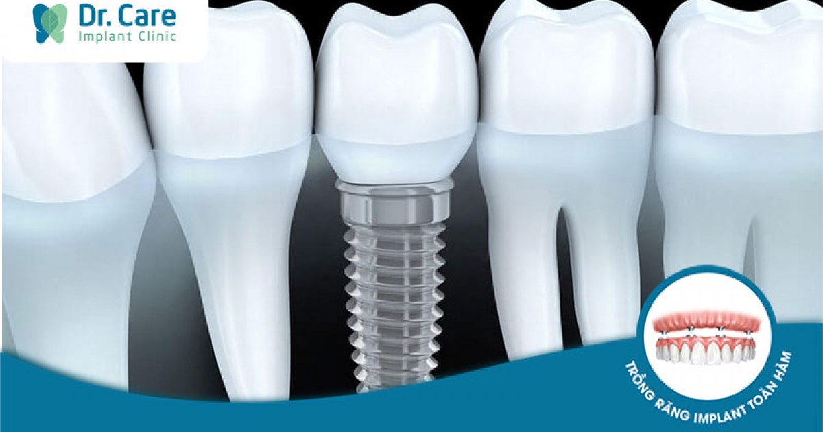 Top 6 Nha khoa cắm Implant uy tín tại Bình Thạnh | Dr. Care