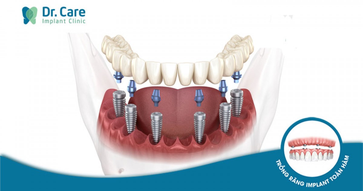 [CHI TIẾT] - 3 Phương pháp trồng răng Implant hàm dưới | Dr. Care
