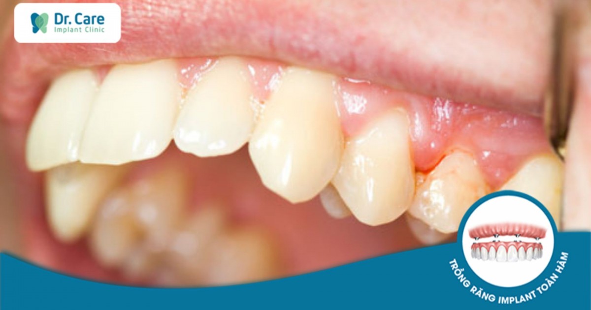 Lệch khớp cắn ảnh hưởng như thế nào đến răng bọc sứ?
