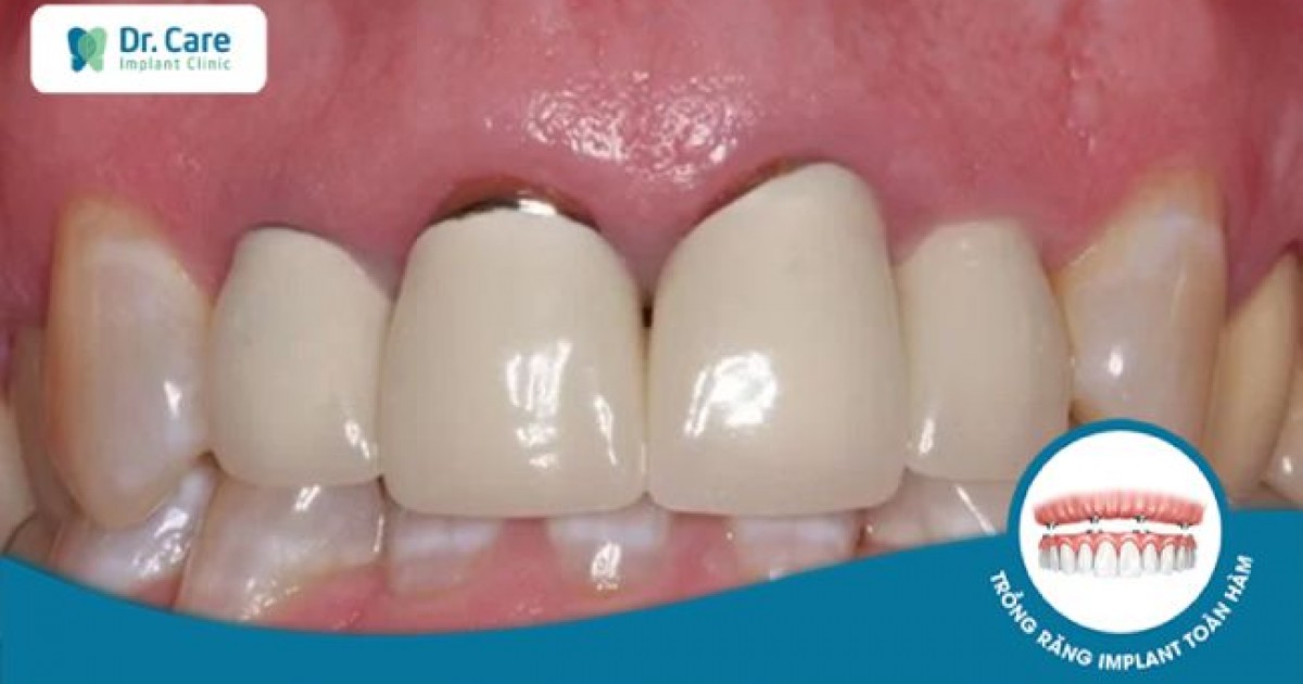 Tại sao phần chân răng bị hở sau khi bọc răng sứ?

