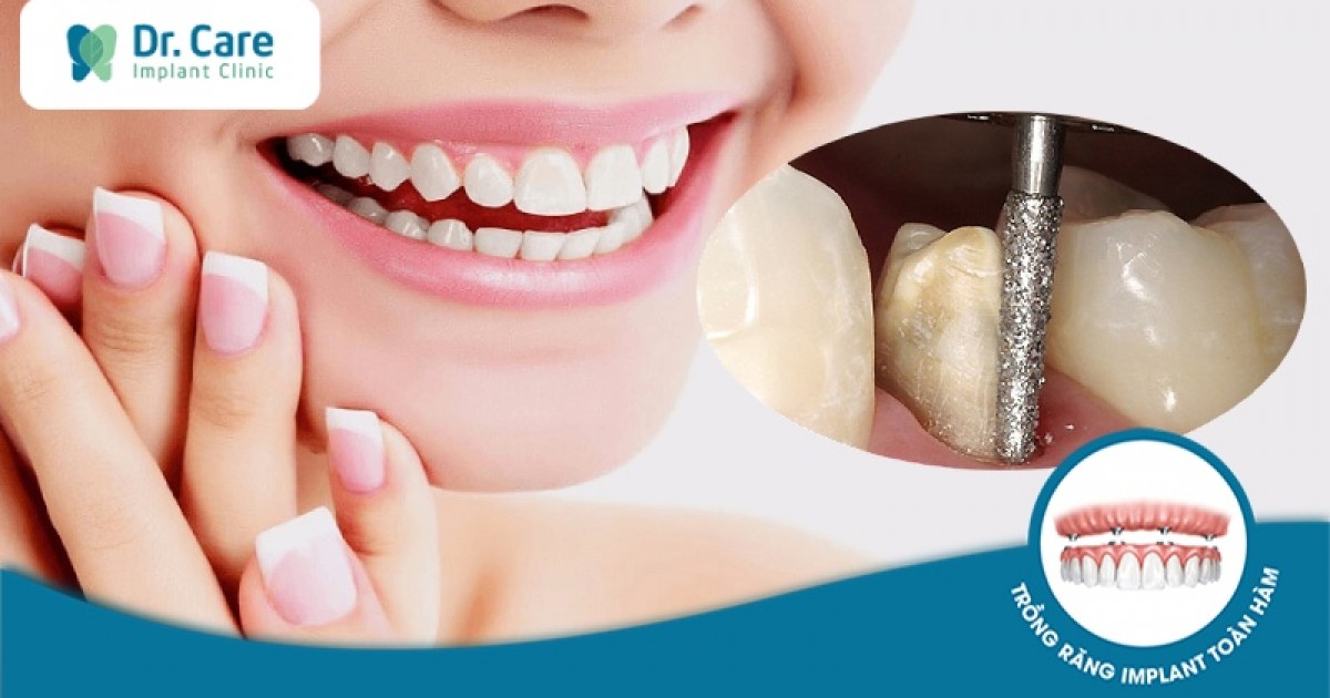 Răng trám bị hỏng có thể khắc phục bằng bọc răng sứ không?
