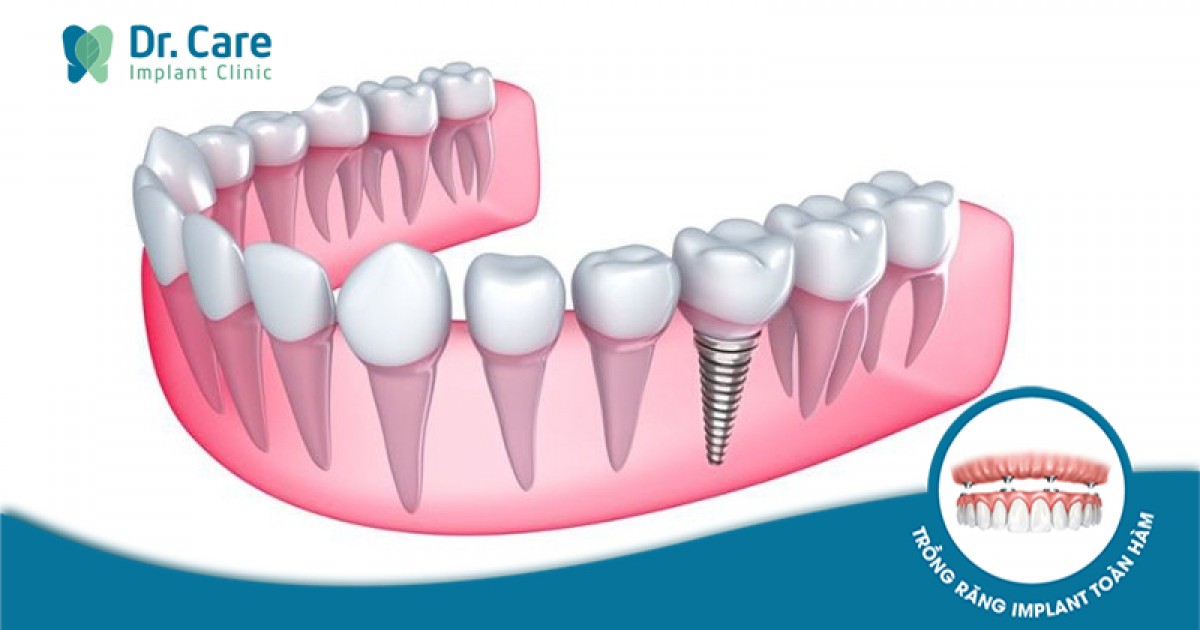 Có những biện pháp nào để bảo vệ và chăm sóc răng số 5 để tránh mất?
