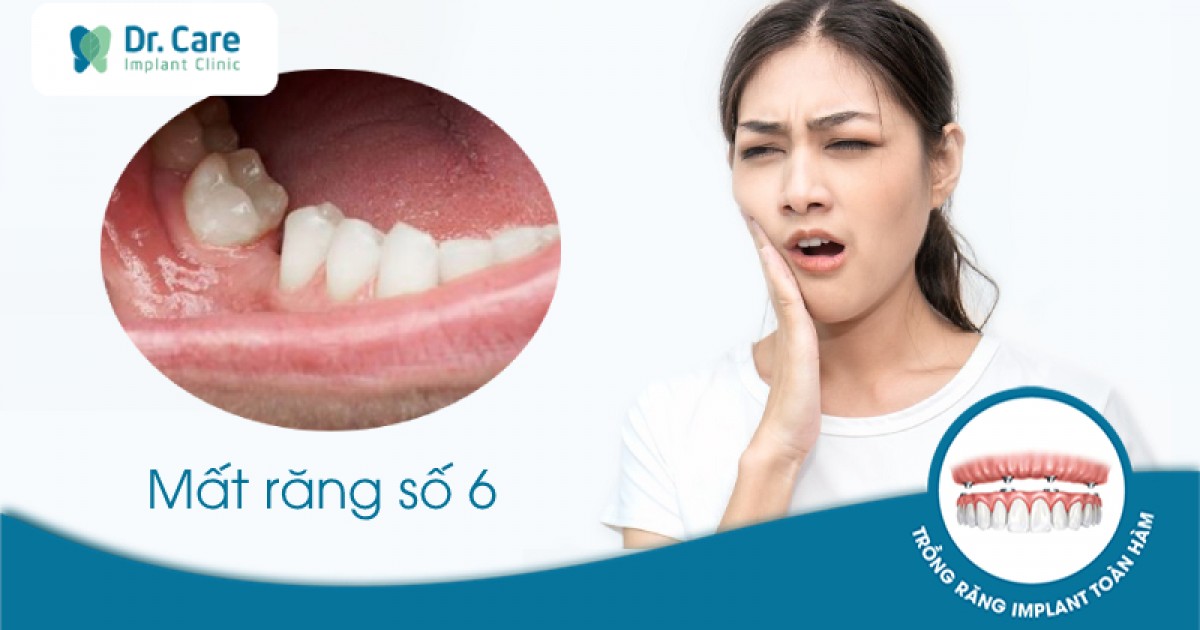 Loại răng nào thường được sử dụng cho trồng răng số 6?
