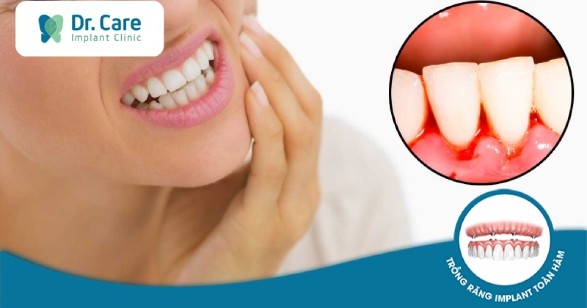 Cách phòng ngừa chảy máu chân răng?
