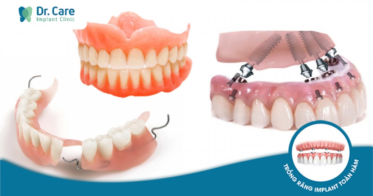 Răng hàm giả bị hỏng hoặc mất, cần thay thế như thế nào?
