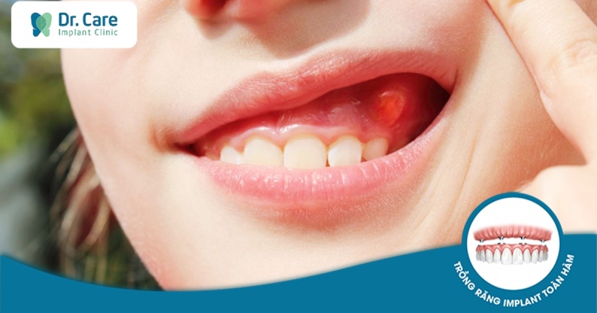 Tác động của sâu răng và sưng lợi có mủ lên sức khỏe nói chung?
