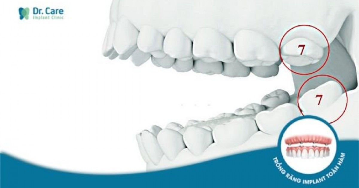 Quá trình trồng răng implant số 7 như thế nào?
