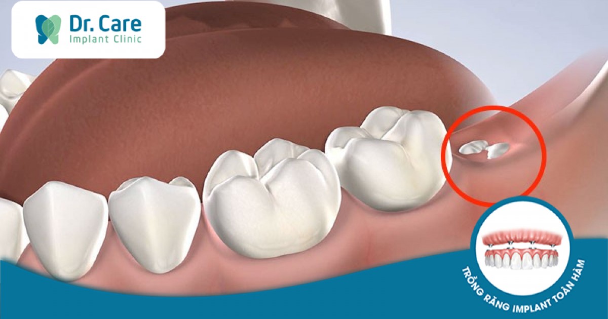 Có những biến chứng nào có thể xảy ra sau khi nhổ răng khôn?
