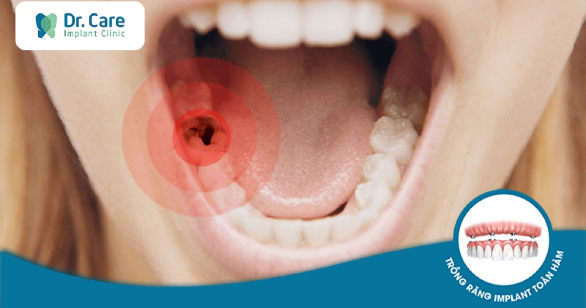 Các vấn đề và biến chứng có thể xảy ra do sâu răng hàm nặng?
