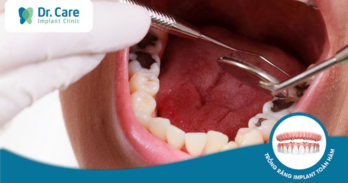 Đau nhức một thời gian sau khi nhổ răng khôn có phải là dấu hiệu nhiễm trùng không?
