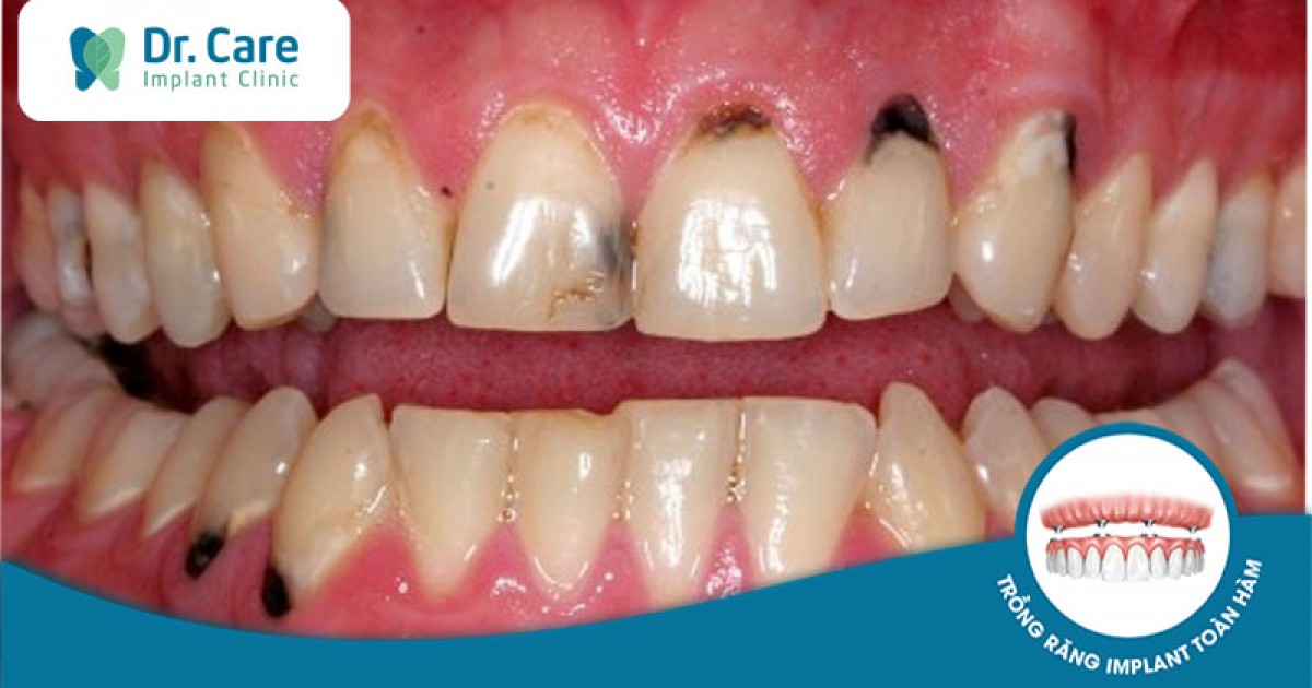 Răng bị vết đen có nguyên nhân chính là gì?