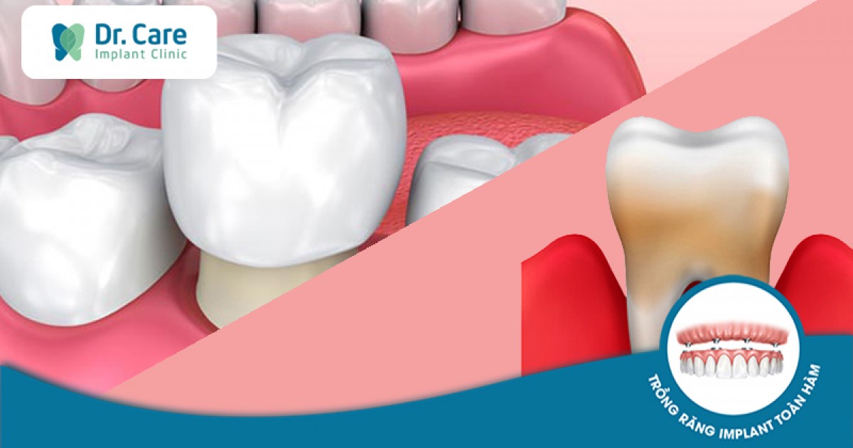 Những yếu tố nào ảnh hưởng đến lựa chọn bọc răng sứ cho người bị nha chu?
