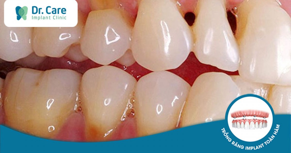 Sâu răng cửa có ảnh hưởng như thế nào đến sức khỏe răng miệng?
