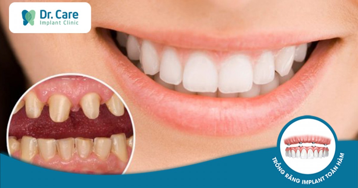 Tìm hiểu về bọc răng sứ tiếng anh là gì?