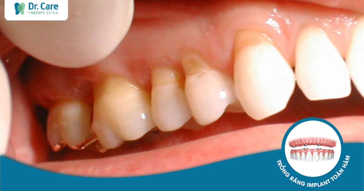 Cách khắc phục cổ răng bị mòn?
