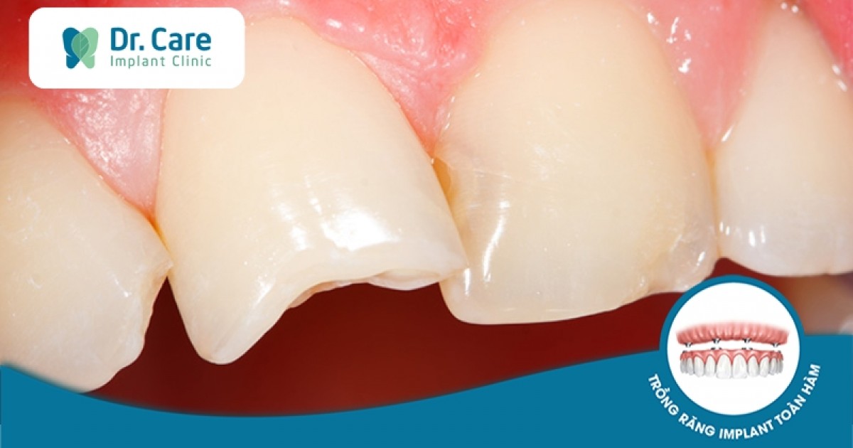 Thời gian hồi phục sau khi gãy răng hàm là bao lâu? 
