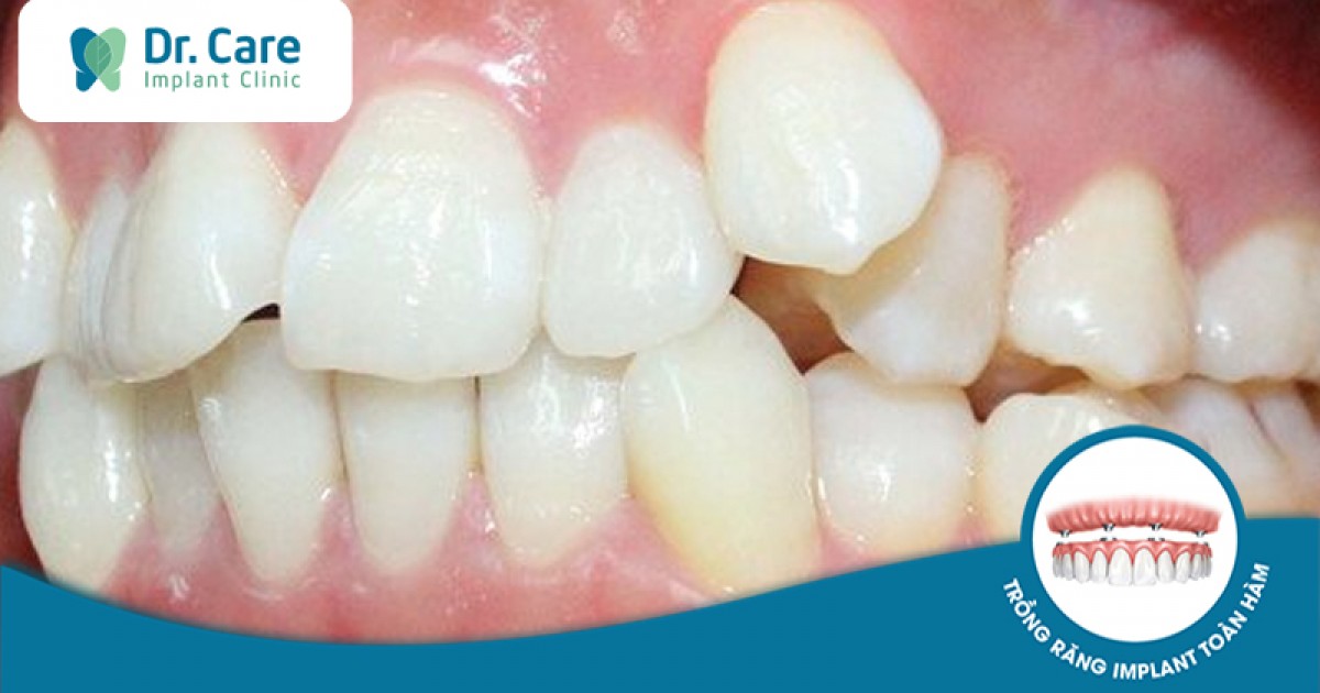 Tại sao răng hàm dưới bị lệch vào trong?