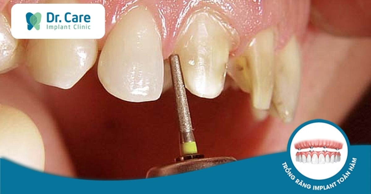 Tại sao sau khi mài răng có thể gây đau?
