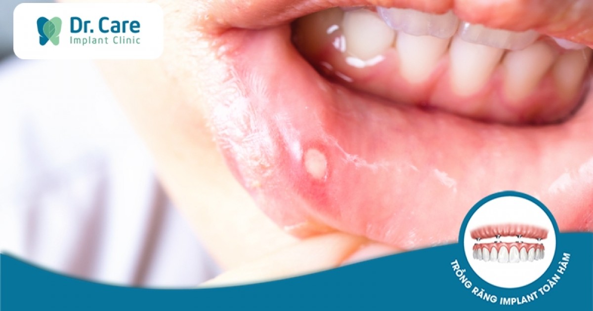 Các triệu chứng của ung thư răng là gì?
