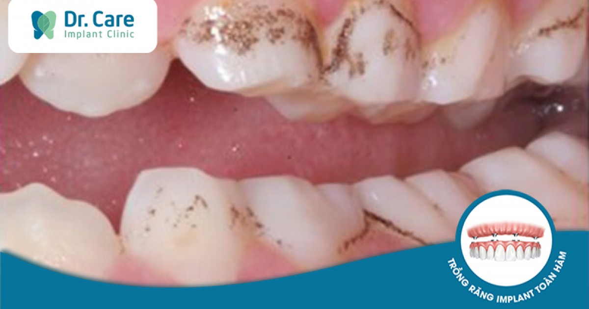 Răng xỉn màu đen có liên quan đến vệ sinh răng miệng hàng ngày không?
