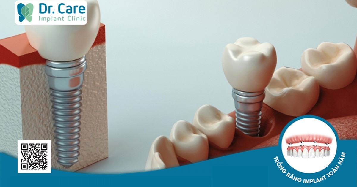 Những nguyên nhân nào dẫn đến trồng răng implant thất bại?
