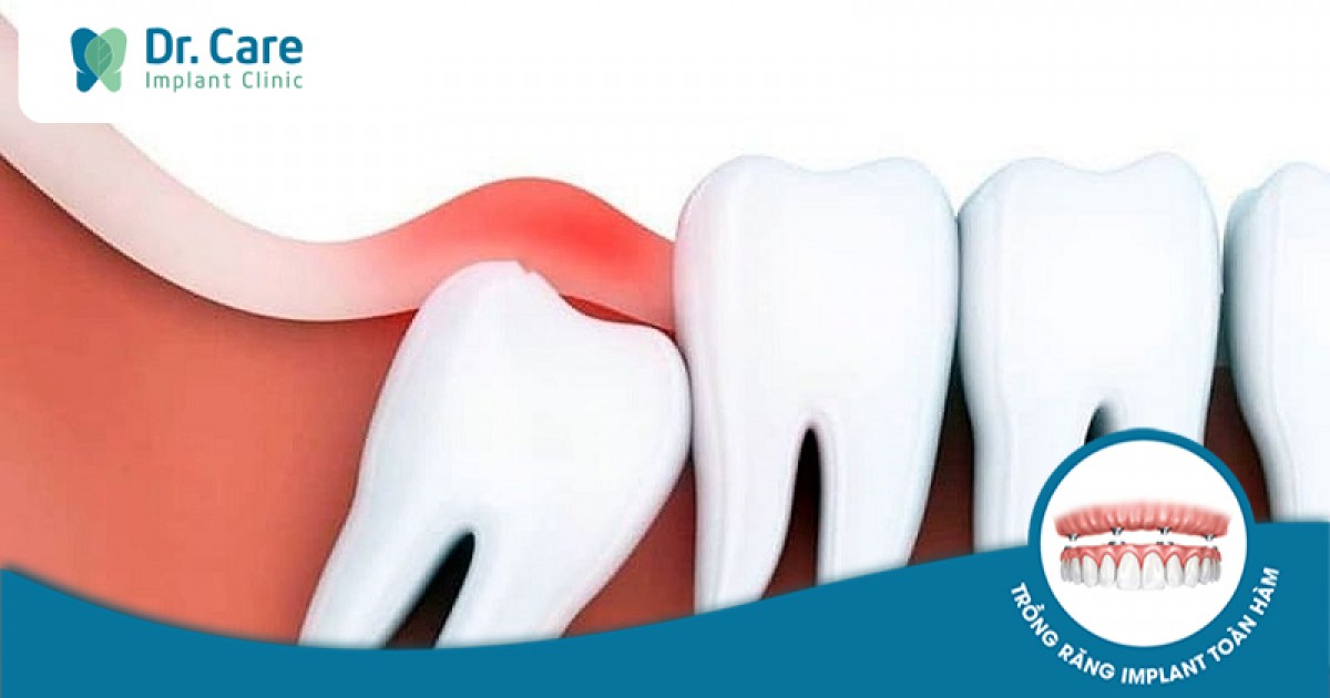 Sưng lợi và đau răng khôn có nguy hiểm hay không? Có cần điều trị ngay lập tức không?
