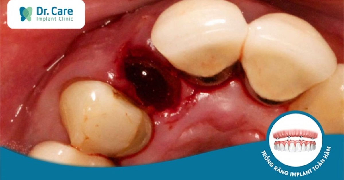 Quá trình viêm ổ răng khô diễn ra như thế nào?
