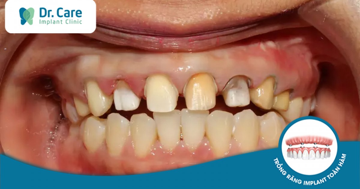 Việc bọc răng sứ có tác động tiêu cực đến cấu trúc răng thật không?
