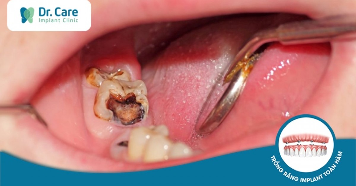Quy trình điều trị sâu răng nặng bao gồm những bước nào?
