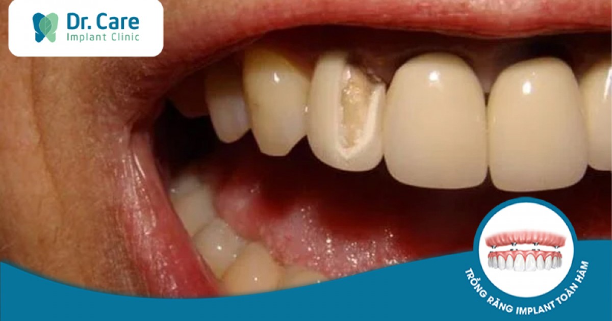 Những nguyên nhân gây ra viêm tủy cho răng bọc sứ?
