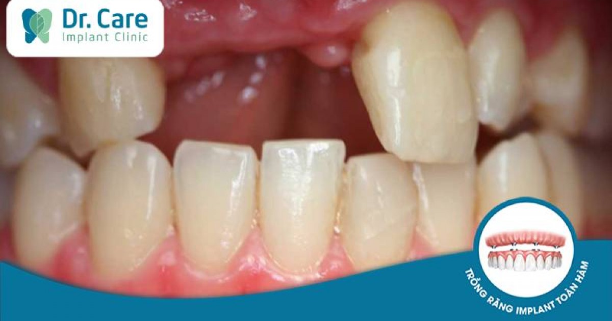 Làm thế nào để khắc phục khoảng trống do mất 2 răng hàm?
