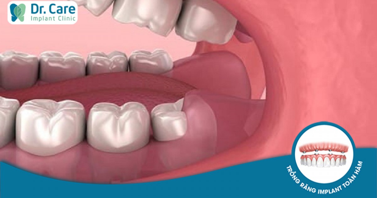 Nguyên nhân và cách trị sưng đau nướu răng trong cùng hiệu quả