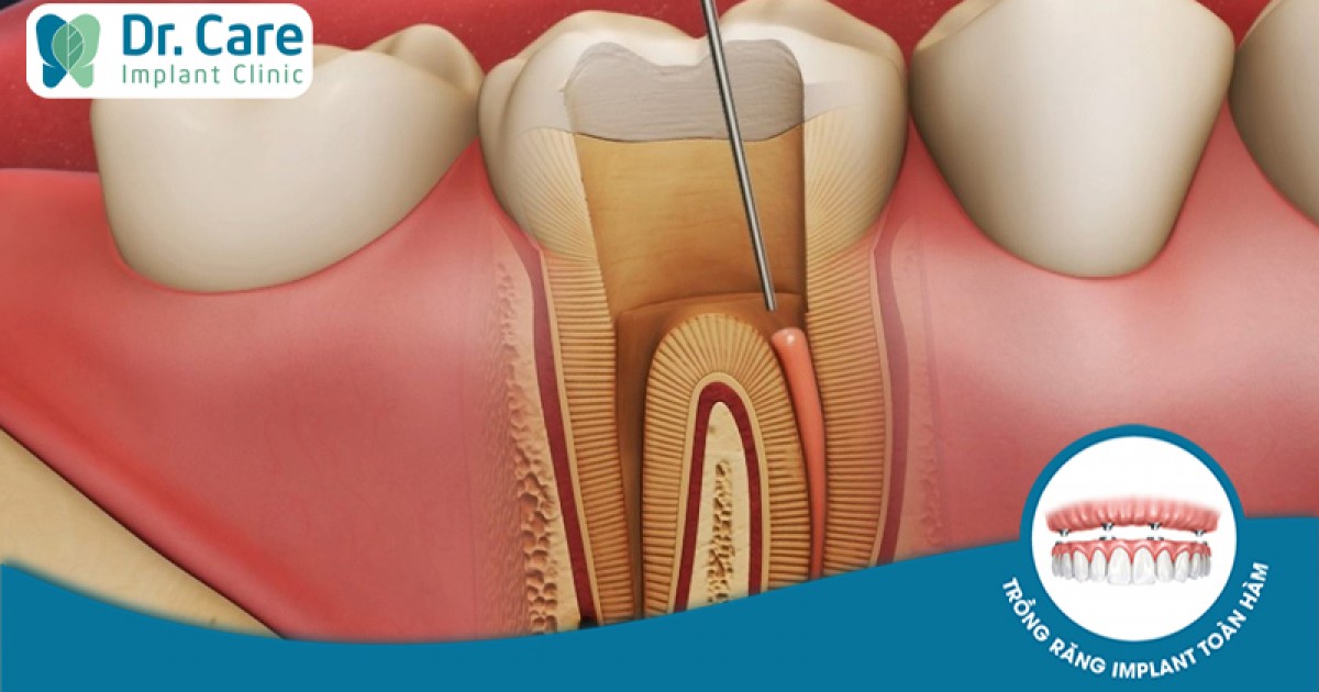 Có cách nào để giảm đau sau khi lấy tủy răng?

