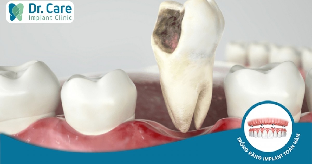 Nhanh chóng và an toàn như thế nào khi nhổ răng hàm bị sâu bằng công nghệ Piezotome?
