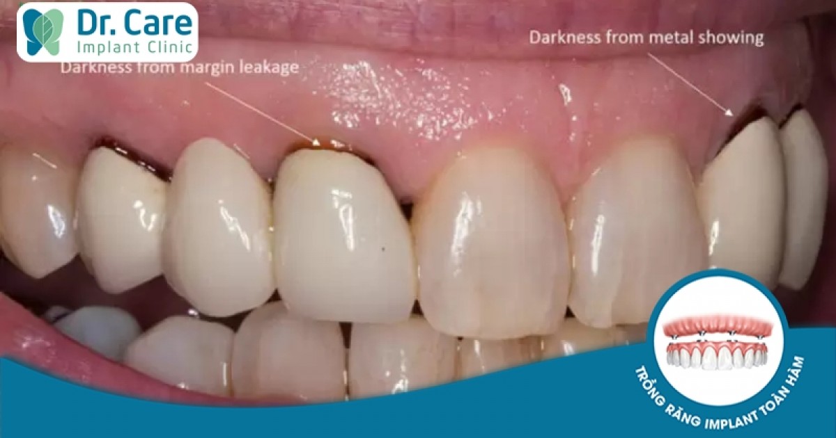 Phương pháp mài cùi răng để điều trị răng bị đen là gì?
