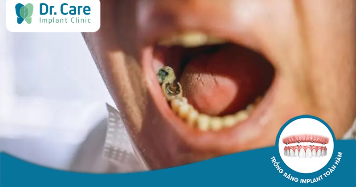 Kiến thức nào về vệ sinh răng miệng cần biết để tránh sâu răng ở người lớn?

