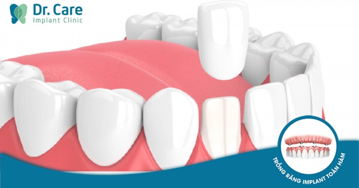 Đặc điểm của phương pháp dán phủ sứ răng?
