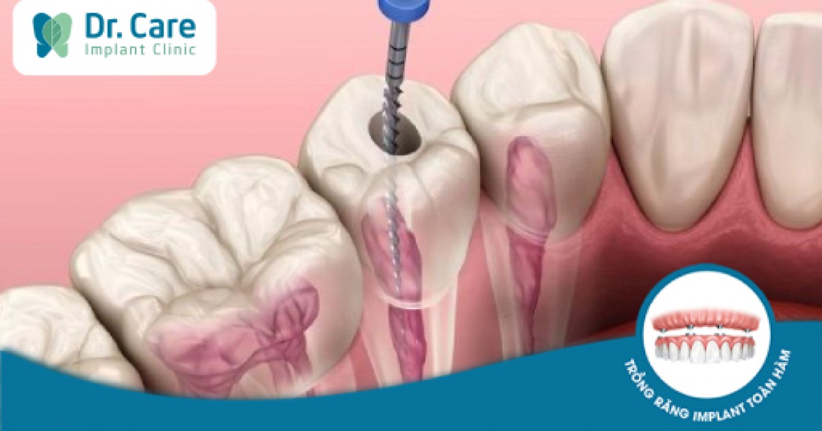 Quy trình răng lấy tủy như thế nào?
