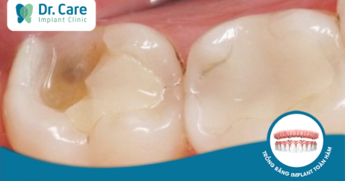 Răng lấy tủy bị vỡ thì phải làm gì để khắc phục?