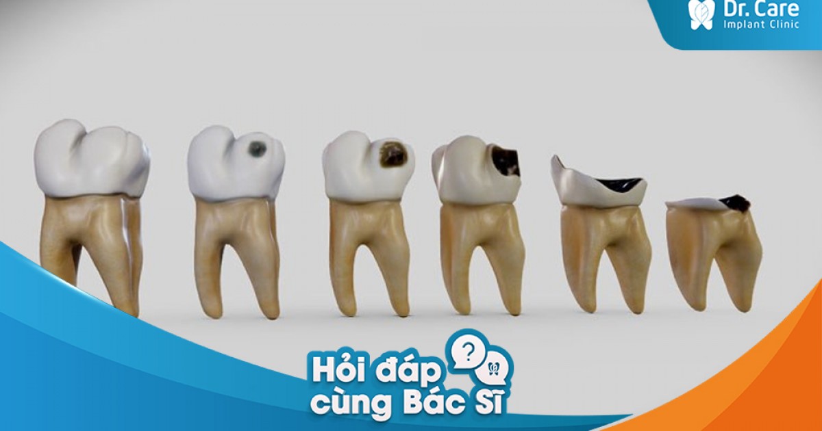 [Hỏi đáp bác sĩ] - Những bệnh lý nào có thể dẫn đến việc mất răng? | Dr ...