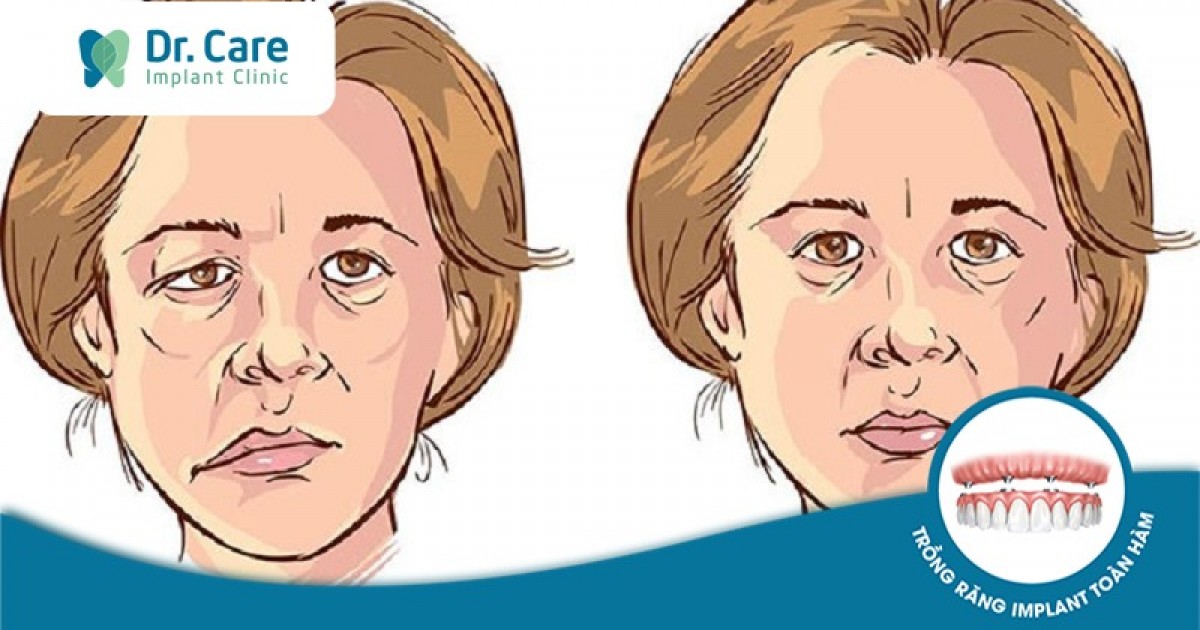 Mặt lệch bên trái: Dấu hiệu, nguyên nhân và cách khắc phục | Dr. Care