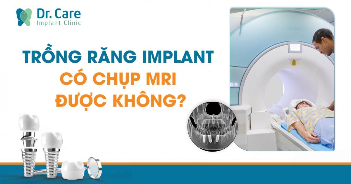 Kết Luận: Trồng Răng Implant Và An Toàn Khi Chụp MRI