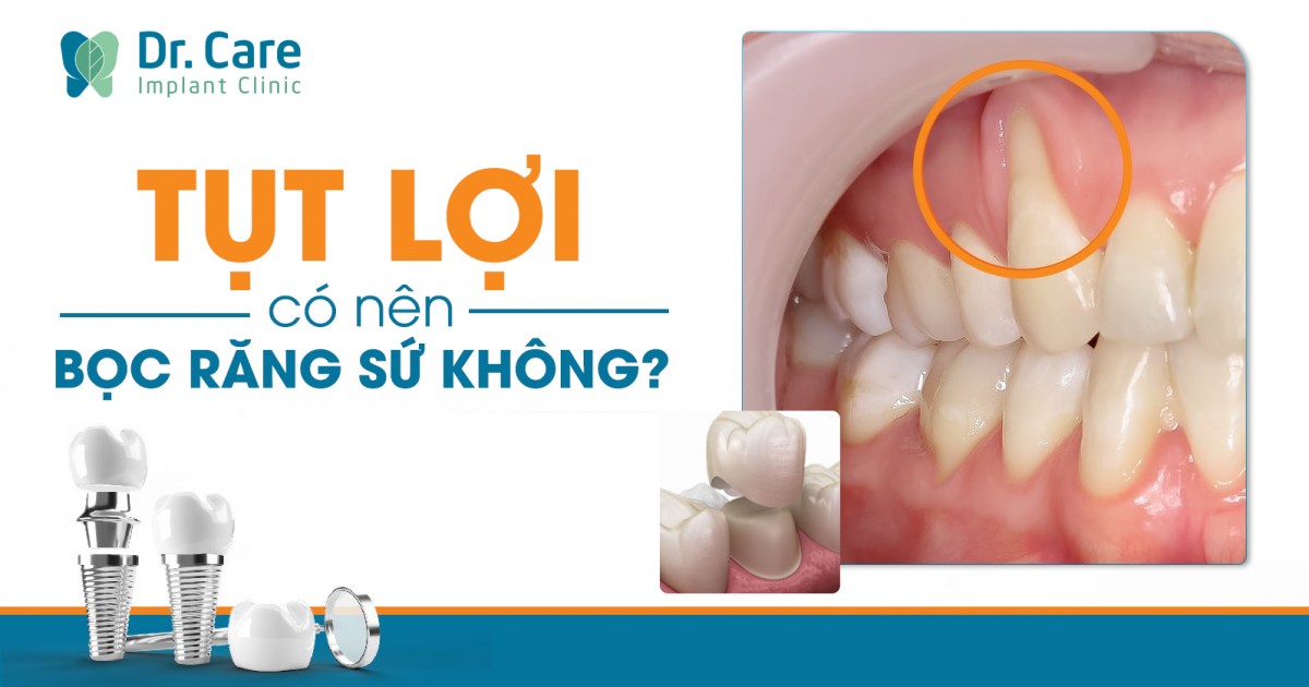 Tụt lợi có nên bọc răng sứ? Giải pháp hiệu quả cho sức khỏe răng miệng