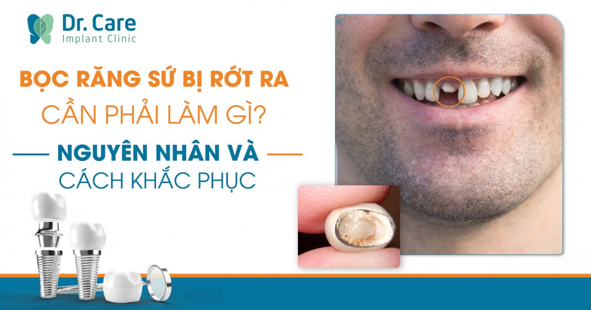 Răng Implant Bị Rớt: Nguyên Nhân, Cách Phòng Ngừa và Giải Pháp Khắc Phục Hiệu Quả