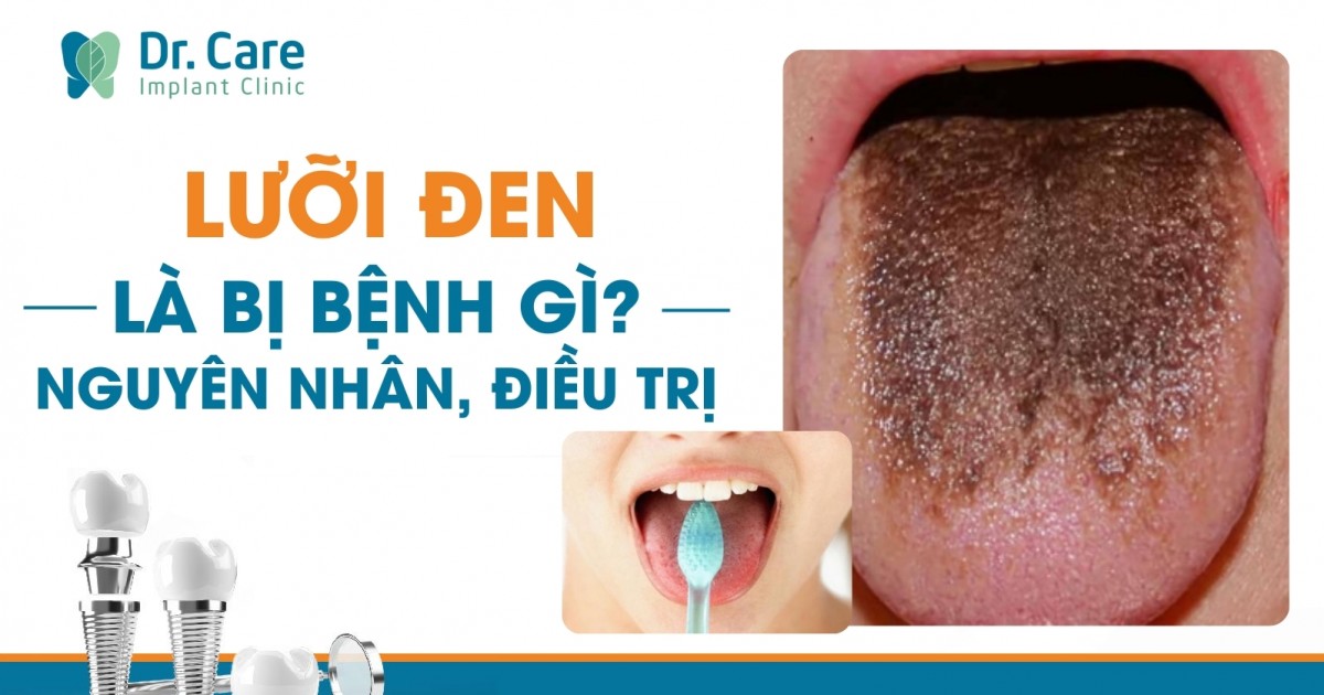 7. Câu Hỏi Thường Gặp Về Lưỡi Đen