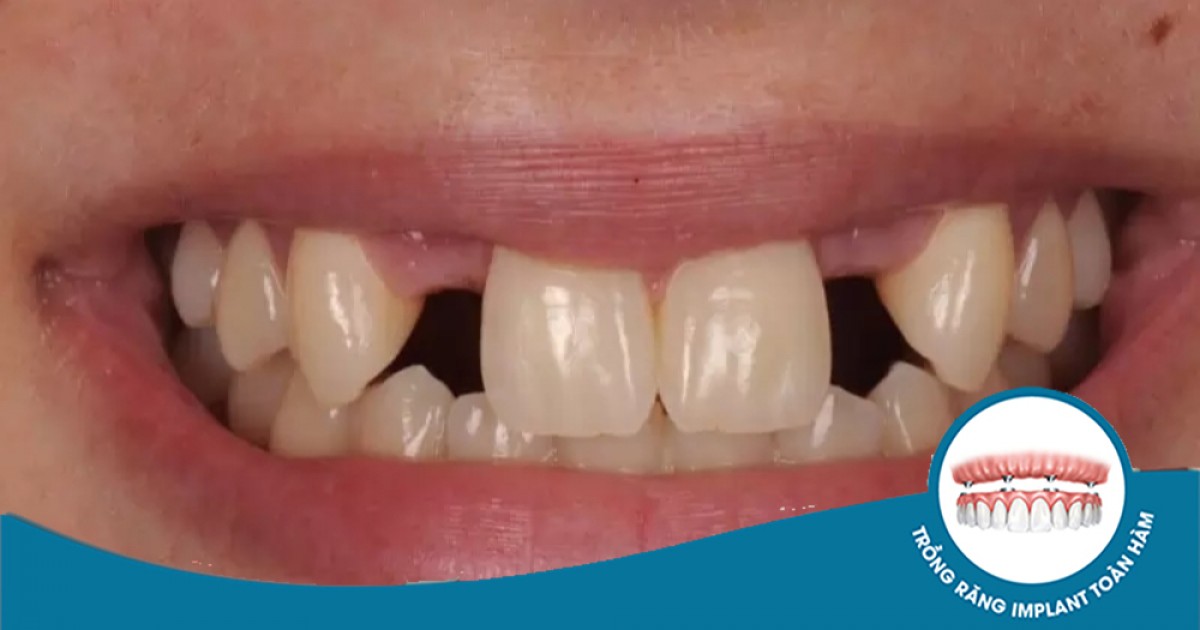 Mama Rang Mầm răng là gì? Vì sao thiếu mầm răng gây ra mất răng vĩnh viễn | Dr. Care