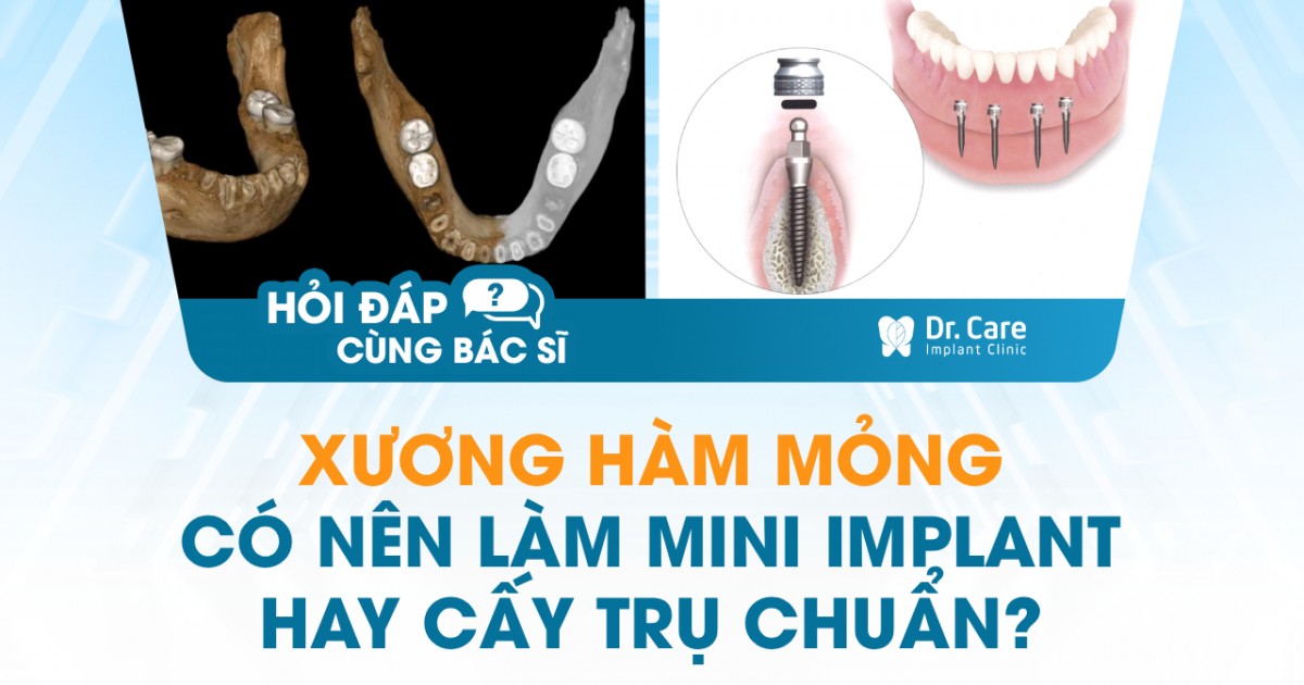 [HỎI ĐÁP BÁC SĨ] – Xương hàm mỏng có nên làm mini Implant hay vẫn có ...