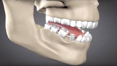 Bệnh loãng xương trong trồng răng Implant