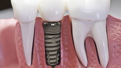 Trồng răng có đau không và nên chọn cách nào?