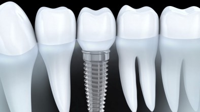 Trồng răng vĩnh viễn phương pháp nào tốt nhất hiện nay?